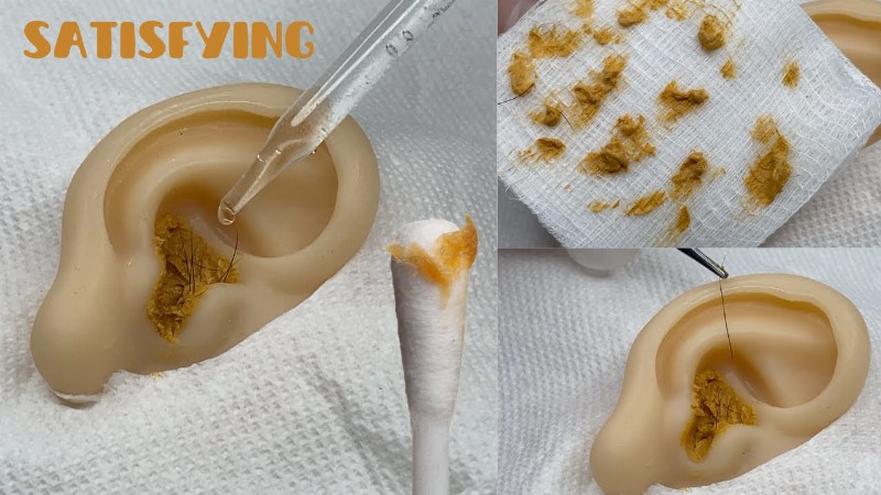 image 0 [asmr] Silicon Ear Cleaning : Tons Of Wax : Satisfying